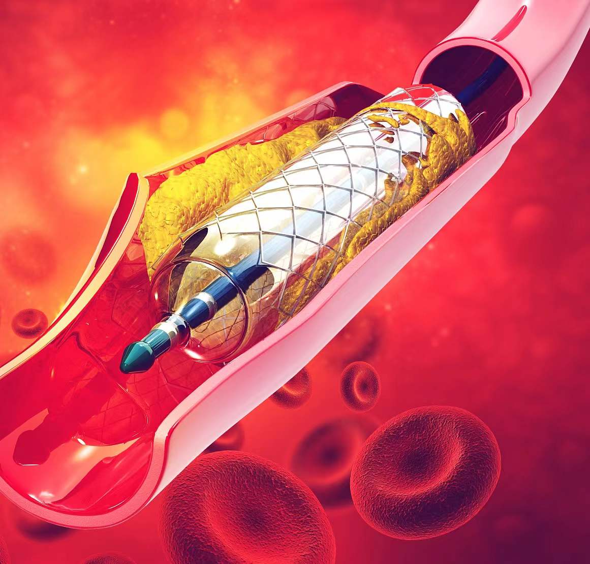 奧泰康服務于創(chuàng)新前沿-PartⅢ：外周血管（上）